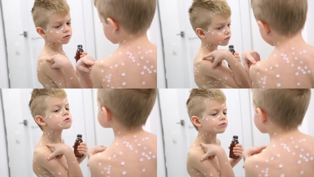 小男孩在镜子里检查自己。儿童水痘病毒或水痘泡沫皮疹