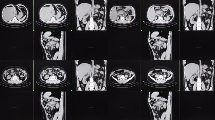 急性胰腺炎患者腹部的CT电影扫描。