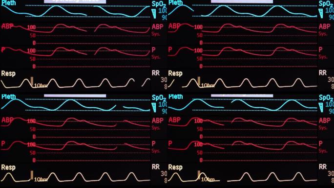 生命体征监测屏幕医疗监测