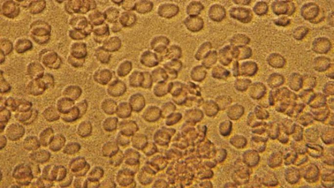 人体血细胞测试的显微镜。放大600倍，在显微镜下详细移动红细胞和白细胞。实验室分析。