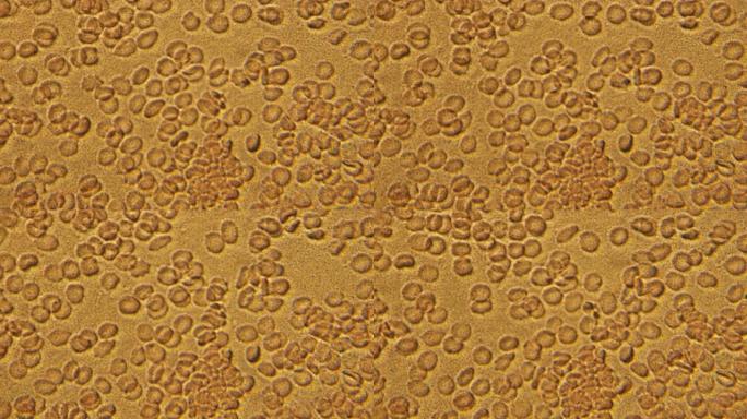 人体血细胞测试的显微镜。放大600倍，在显微镜下详细移动红细胞和白细胞。实验室分析。