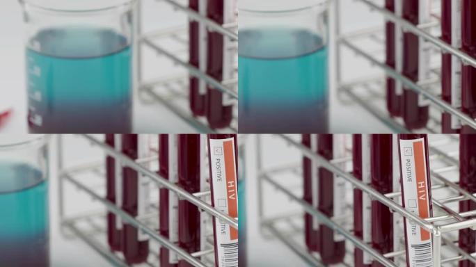 实验室用血样试管进行HIV检测，实验室用血样检测诊断病毒感染，艾滋病感染概念