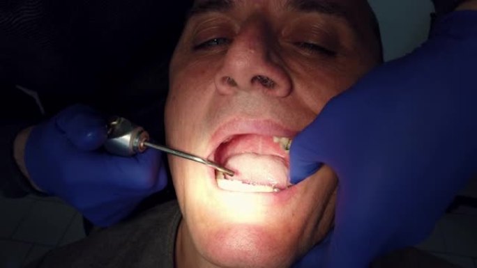 由牙医医生添加具有各种色调的植入物