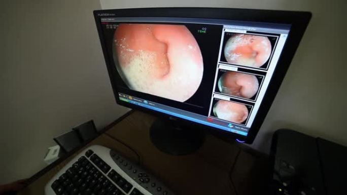 医生使用医疗仪器和摄像机进行腹部手术库存视频
