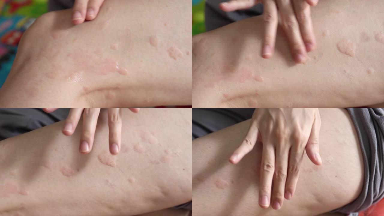 妇女应用皮疹荨麻疹或过敏身体