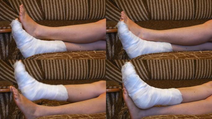 石膏石膏上的女人腿。脚趾在移动。女孩在沙发上舔。腿部骨折。