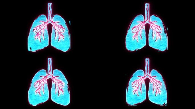 全息数字肺中的肺水肿，它是窒息的象征，非常危险