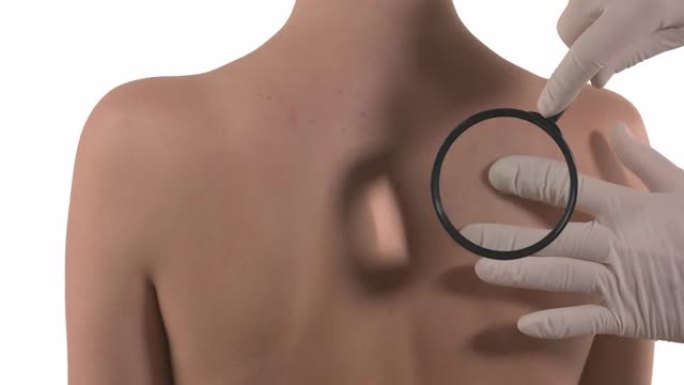 白种人妇女背部的静态镜头聚焦，痣和医生的手戴着手套触诊胎记。专家的皮肤状况检查。孤立在白色背景上。