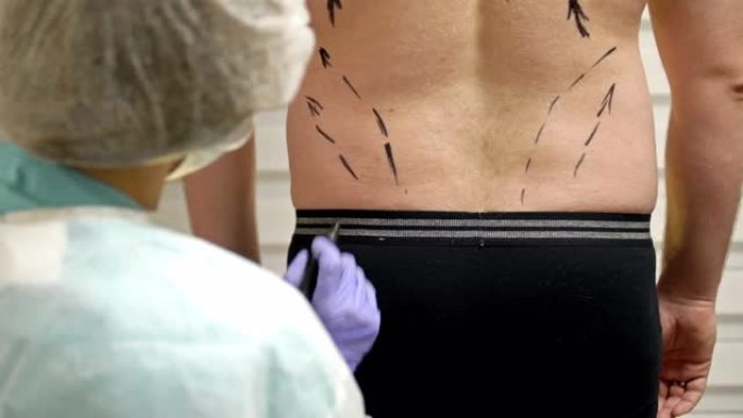 整形外科医生为抽脂手术准备病人。医生用记号笔在男性身上画线