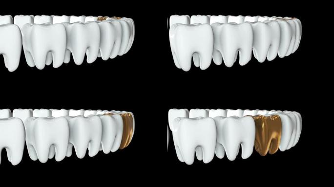 一排白色牙齿中的金色牙齿。3D渲染。牙科，出众，经营理念