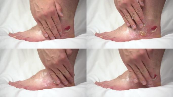 一名男子用二级热水烧伤在腿上涂抹药膏。皮肤肿胀成肿块。