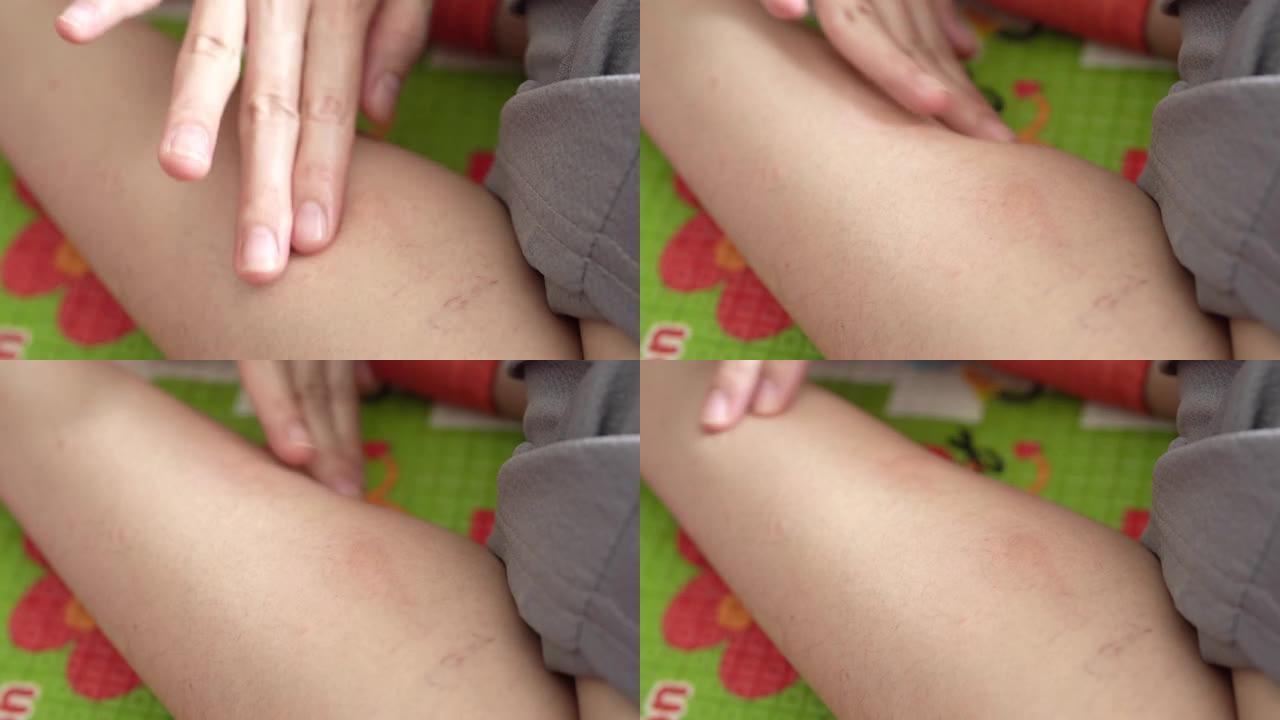妇女应用皮疹荨麻疹或过敏身体