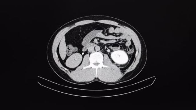 输尿管和肾结石患者腹部的CT电影扫描