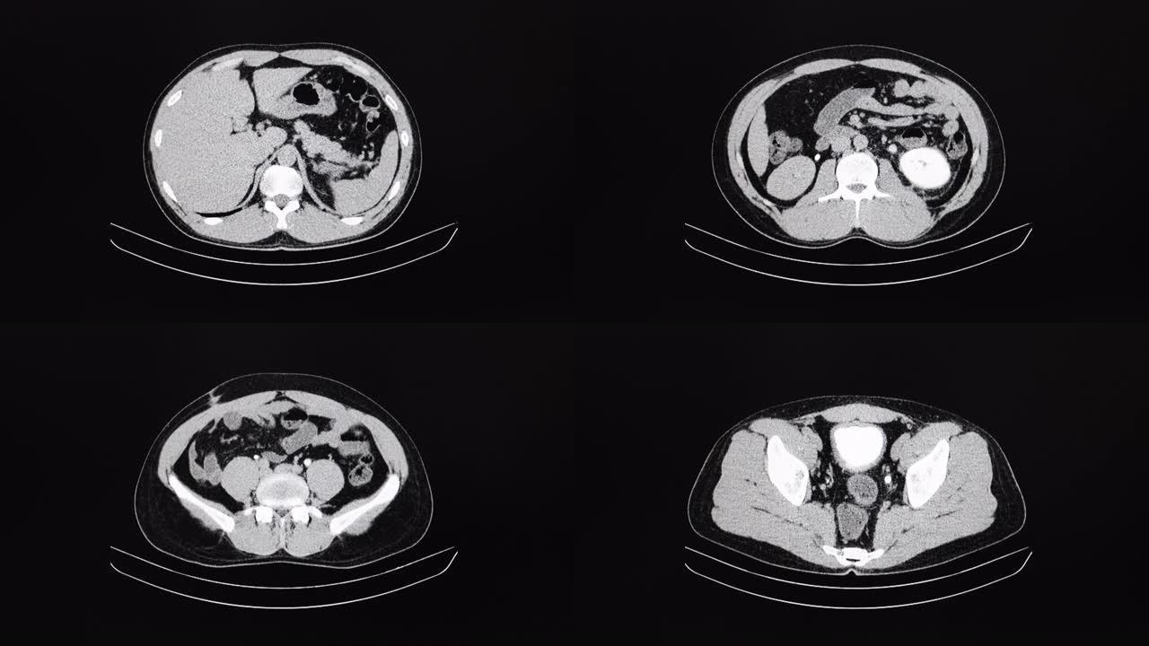 输尿管和肾结石患者腹部的CT电影扫描