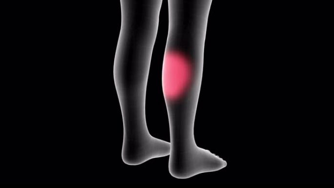 儿童x射线全息图的3d动画显示了带有alpha通道的小腿背部区域的疼痛区域