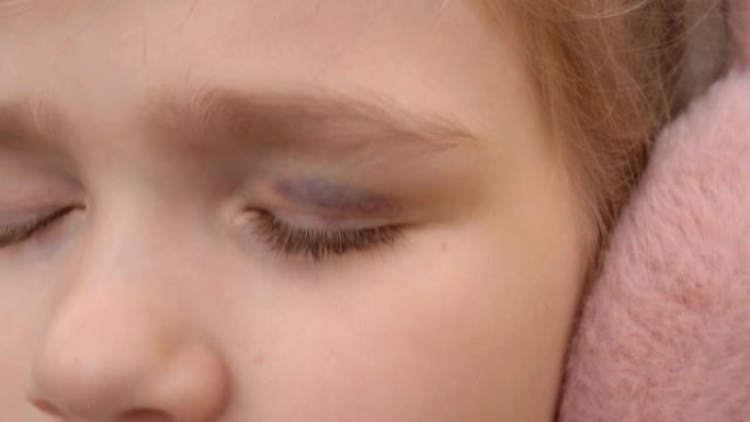 关闭了。小女孩左眼上的淤青。眼睑瘀伤。