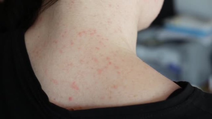 女孩脖子上的皮肤上有红色丘疹。刺激和过敏概念，皮肤科