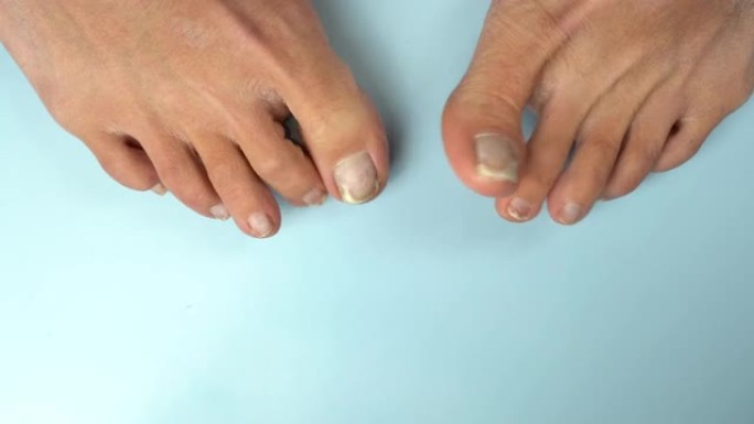 妇女的真菌脚趾甲跳舞。受蓝色真菌影响的脚趾甲