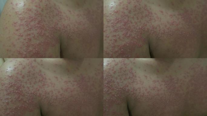 印度尼西亚Tenggarong，2019 7月29日，医院中患有水痘或水痘疾病的患者特写