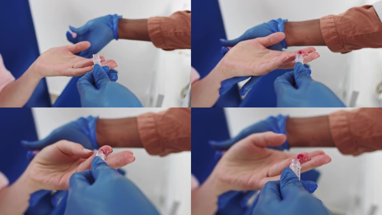 手指血液测试。手戴手套采集血样的特写镜头。血液测试的特写。护士从男性手上抽血。医学检测艾滋病毒。护士