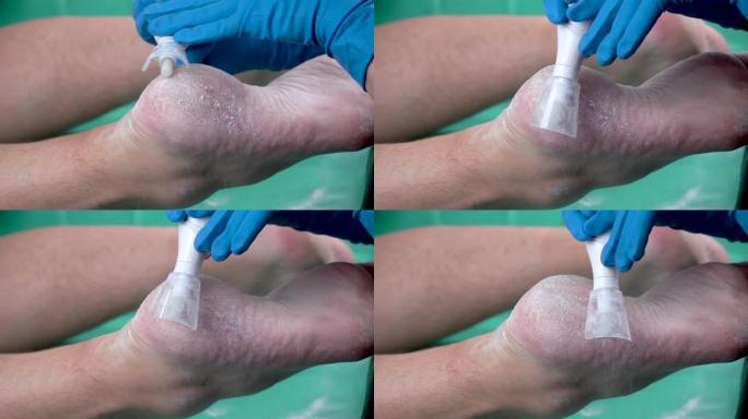 使用专业修脚工具剥离愈伤组织。去除脚上坚硬的老茧皮肤。去除男人脚上的老茧和鸡眼