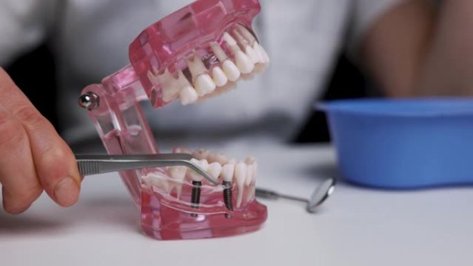 牙医种植学家在人类牙颌模型上展示牙桥种植技术。特写
