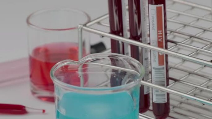 医生的卡车射击将阳性血液样本试管在实验室进行HIV检测，血液检测的实验室样本用于诊断病毒感染，艾滋病