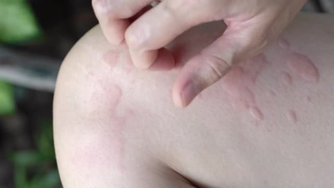 女人的手抓荨麻疹或过敏她的身体
