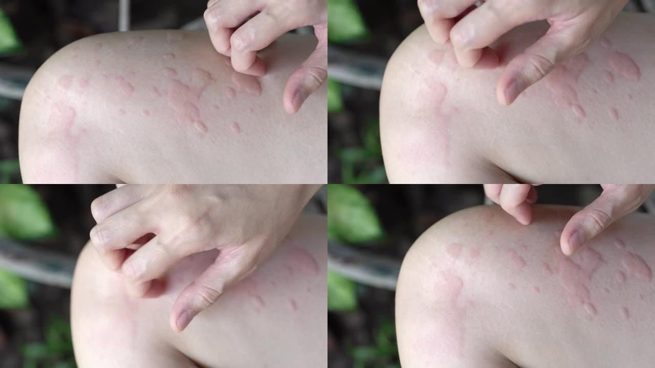 女人的手抓荨麻疹或过敏她的身体