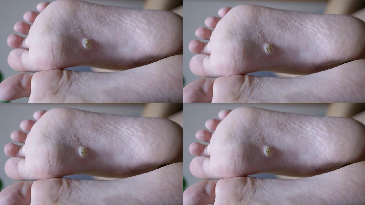 儿童足底扁平足的愈伤组织和疣足。平足。特写