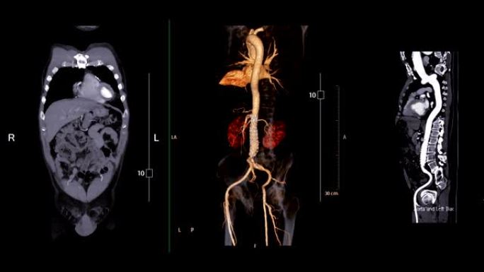 CTA腹主动脉比较冠状面、三维渲染图像和曲线MPR。