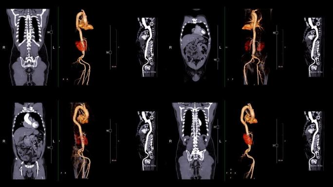 CTA腹主动脉比较冠状面、三维渲染图像和曲线MPR。
