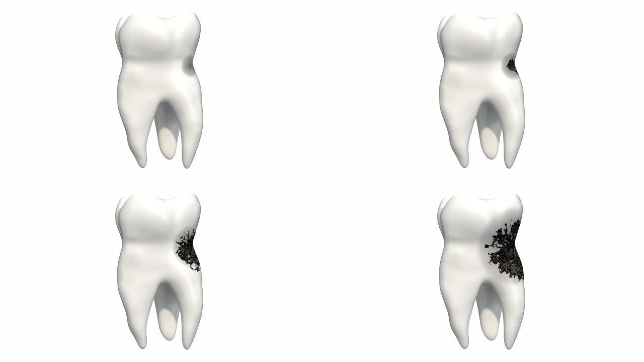 龋齿，3d动画。白色背景上孤立的3D渲染