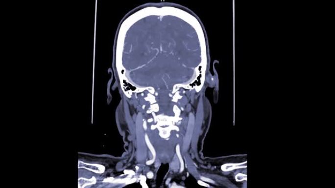 脑冠状面ct扫描。