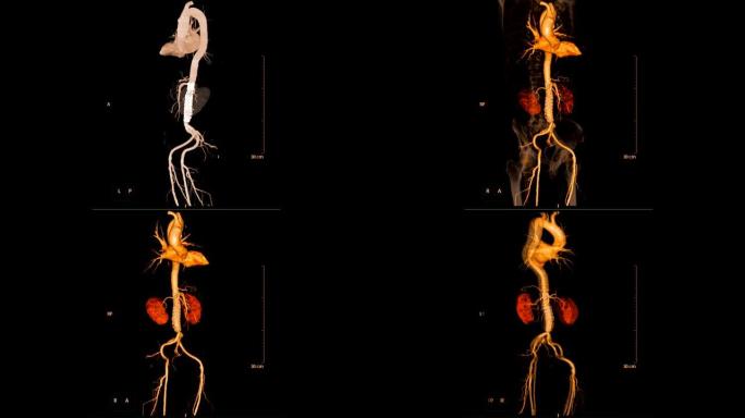 基于MIP MPR技术的CTA腹主动脉2D和3D渲染图像