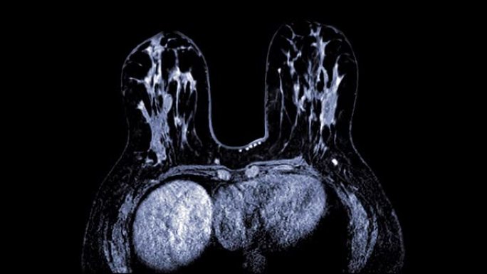 乳腺磁共振成像或MRI乳腺用于筛查乳腺癌轴位视图t2。检查概念。