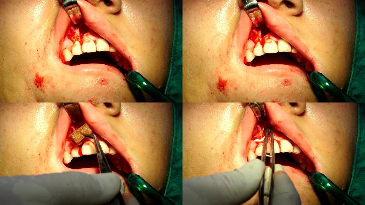 牙齿，牙龈，口腔手术，黑暗手术室中的apicectomia的女孩