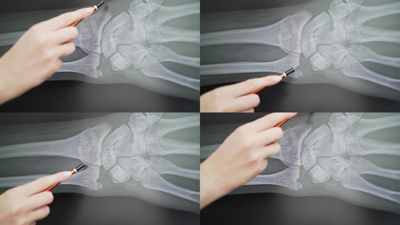 手臂骨折的x光。医院医生指骨折现场特写4k