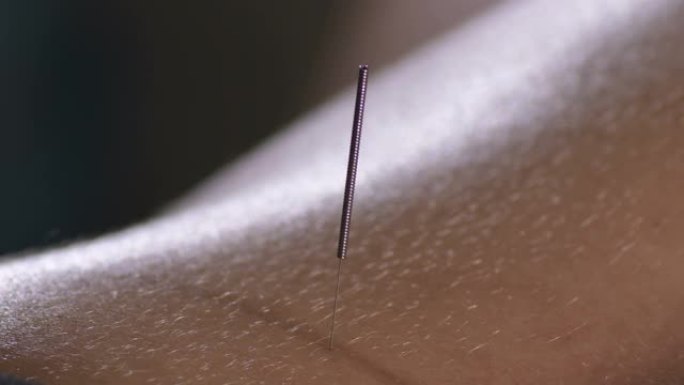 针灸训练中女性背部的针灸针尖刺
