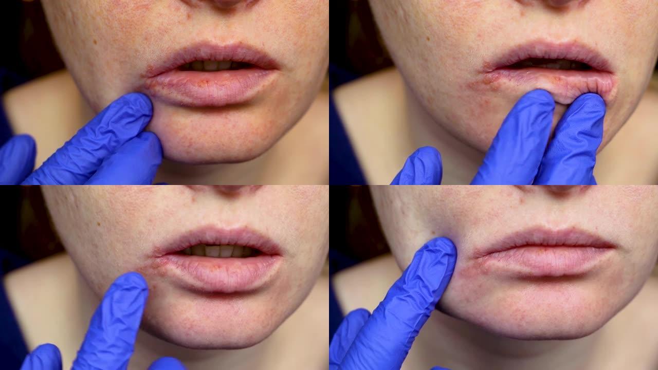 嘴唇上的疱疹: 患有感冒和疱疹病毒的妇女由皮肤科医生和传染病专家检查