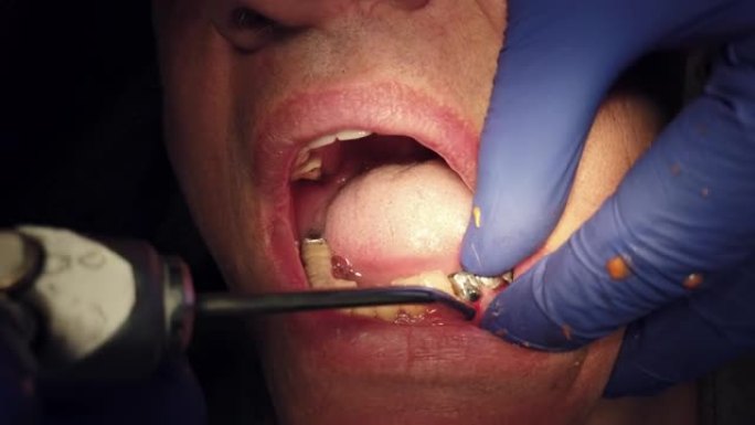 牙科植入物在牙医手中。植入手术正在进行中。钛植入物
