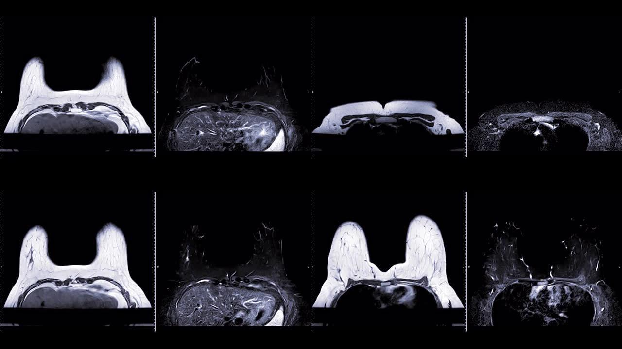 乳腺磁共振成像或MRI乳腺比较t1和t2用于筛查乳腺癌。检查概念。