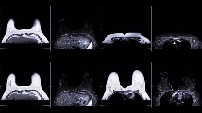 乳腺磁共振成像或MRI乳腺比较t1和t2用于筛查乳腺癌。检查概念。