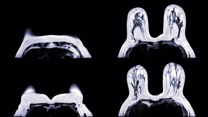 乳腺磁共振成像或MRI乳腺筛查乳腺癌轴位图t1。检查概念。