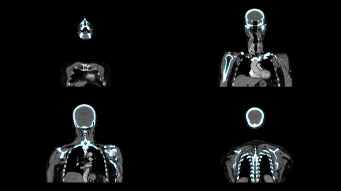 医学MRI扫描屏幕，CT或CAT图像