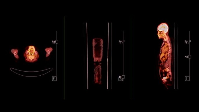 人体全身正电子发射断层扫描或PET CT比较轴向、冠状面和矢状面。