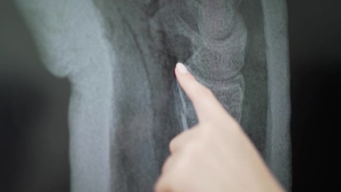 石膏中断臂的x光。医生给病人看受伤的位置。人体骨骼的图片4k