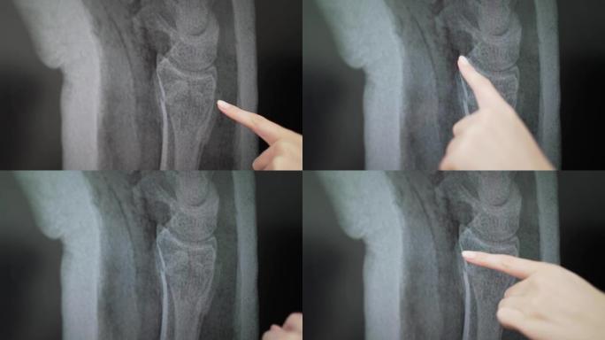 石膏中断臂的x光。医生给病人看受伤的位置。人体骨骼的图片4k