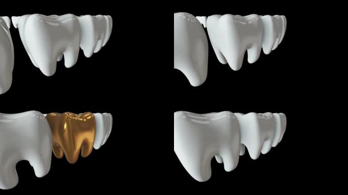 一排白色牙齿中的金色牙齿。3D渲染。牙科，出众，经营理念