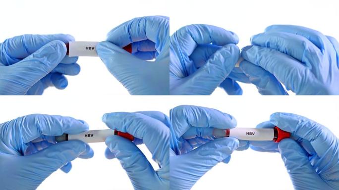 概念血液测试。双手戴着蓝色手套，用真血握住管子。